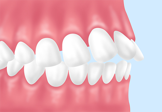 上顎前突（出っ歯）